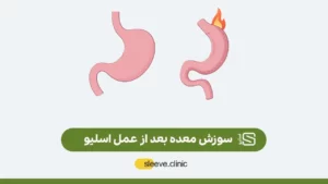 سوزش معده پس از عمل اسلیو