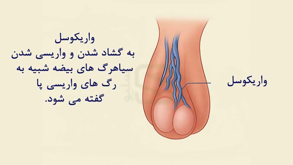 واریکوسل چیست؟