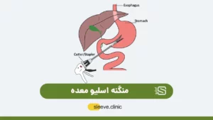 منگنه اسلیو معده