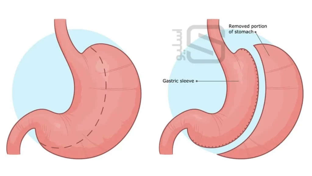 بخیه معده با منگنه اسلیو