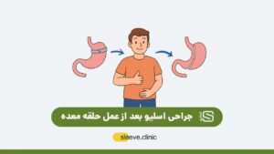 جراحی اسلیو بعد از عمل حلقه معده