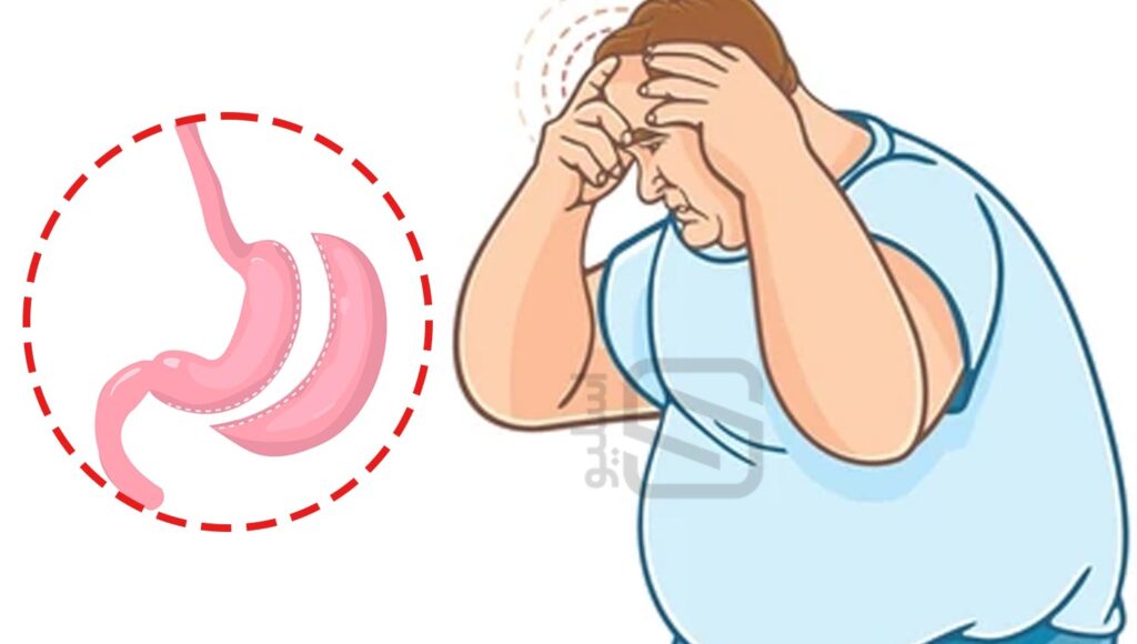 استرس قبل از عمل اسلیو