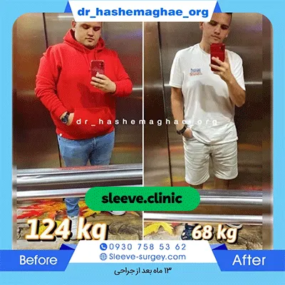 قبل و بعد جراحی اسلیو توسط دکتر مهدی هاشمی آقایی