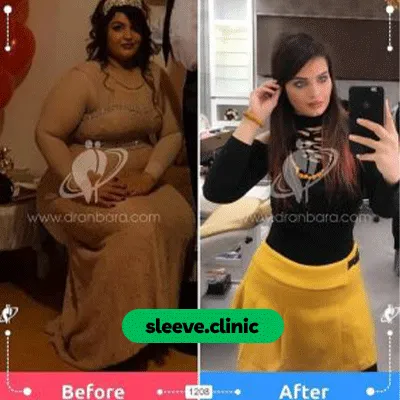 قبل و بعد نمونه کار جراحی لاغری دکتر طاها عنبرا شماره 2