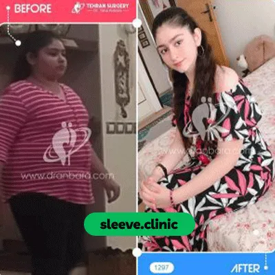 قبل و بعد نمونه کار جراحی لاغری دکتر طاها عنبرا