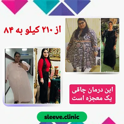 قبل و بعد نمونه کار دیگری  از جراحی لاغری توسط دکتر علیرضا خلج