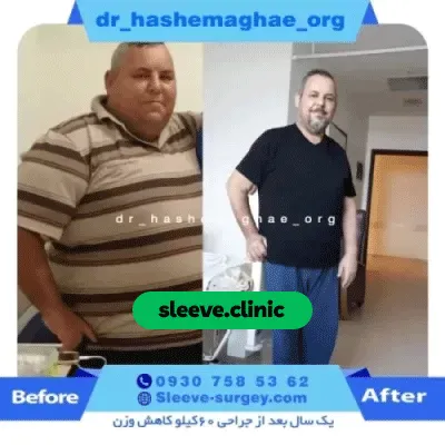 قبل و بعد نمونه کار عمل اسلیو معده دکتر مهدی هاشم آقایی