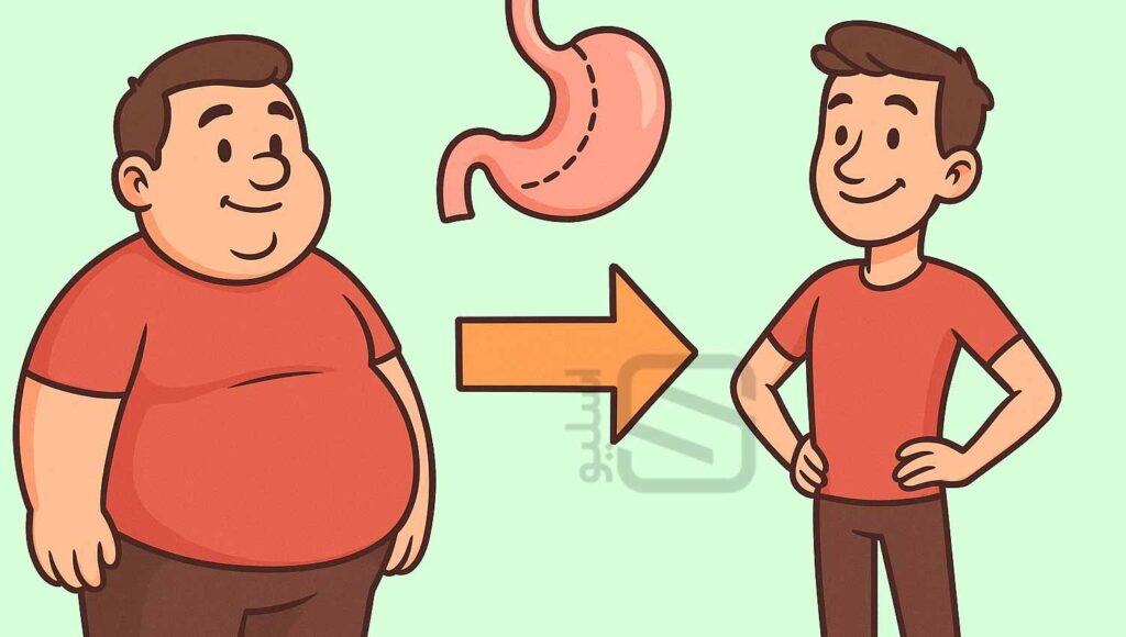 کاهش وزن بعد از عمل اسلیو