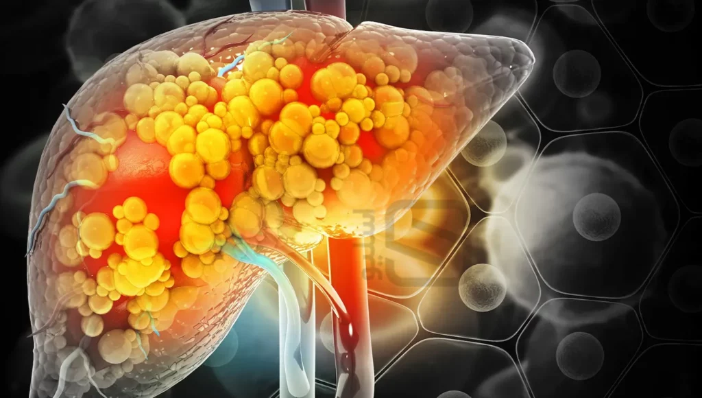 تصویر شماتیک بیماری کبد چرب