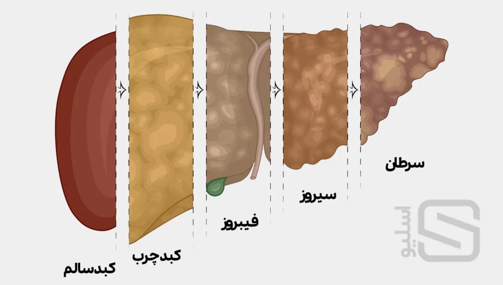 مراحل چرب شدن کبد