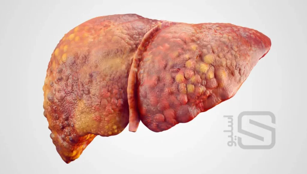 نمای واقعی پیشرفت بیماری کبد چرب