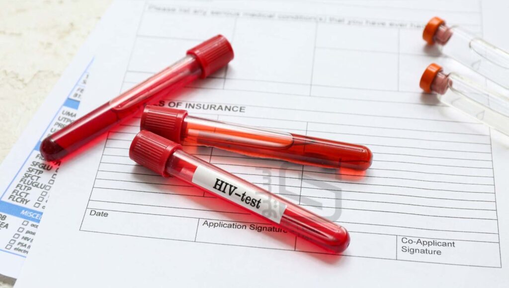 تست HIV