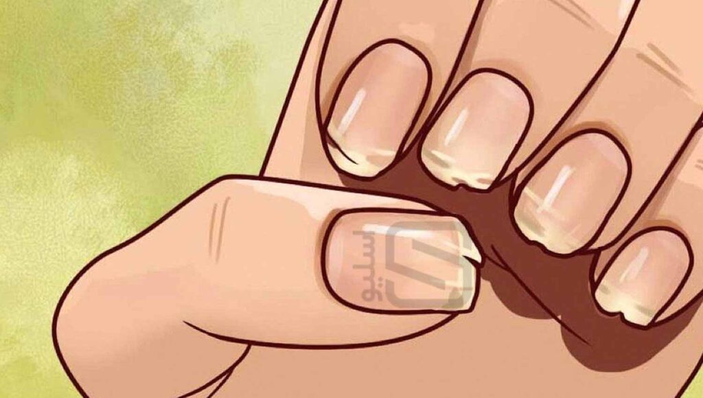 شکستگی ناخن ها