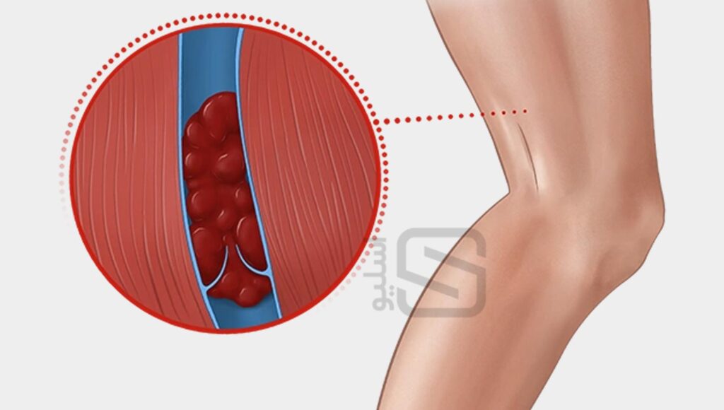 لخته شدن خون در رگ های پا