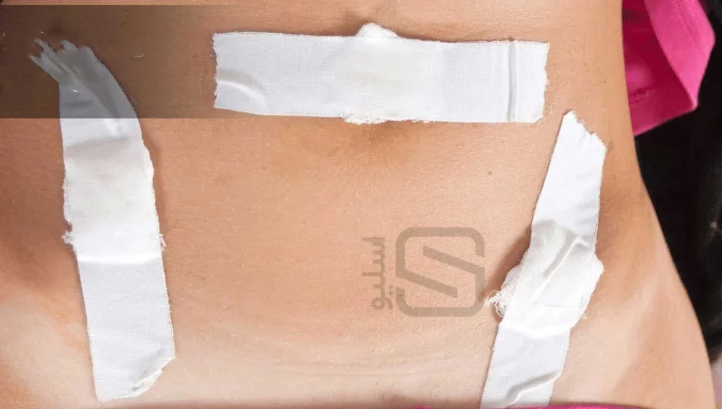 زخم بعد از جراحی لاغری