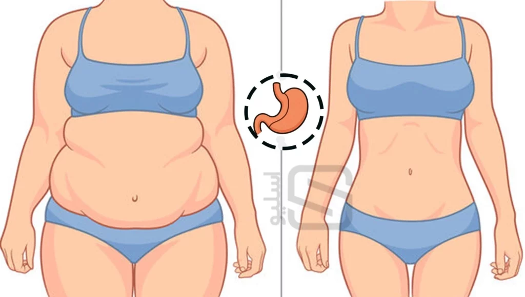 کاهش وزن بعد از عمل لاغری