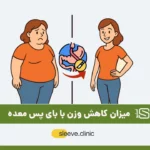 میزان کاهش وزن با بای پس