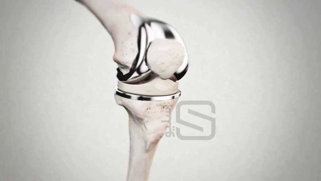 جراحی تعویض مفصل زانو